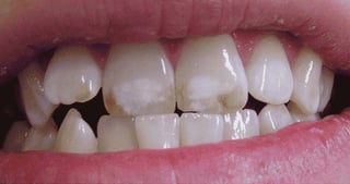 fluorosis06.gif